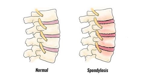 Spondylosis - Symptoms, Causes, Treatment and Rehabilitation