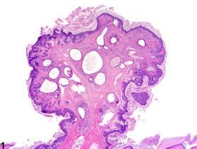 Skin - Fibroadnexal Hamartoma - Nonneoplastic Lesion Atlas