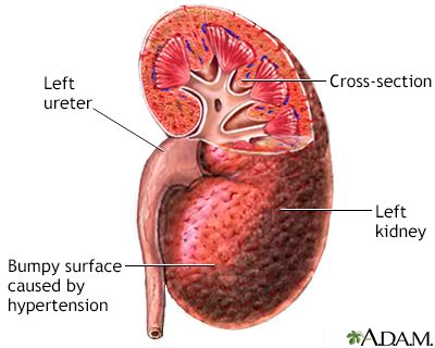 Malignant hypertension Information | Mount Sinai - New York