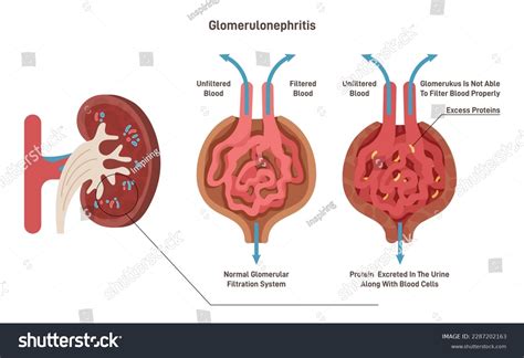 Difference Between Nephrotic And Nephritic Syndrome, 47% OFF