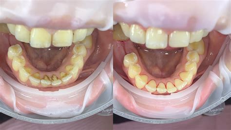 Teeth Cleaning Before And After