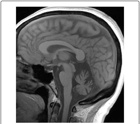 MRI scan without contrast showing severe cerebellar atrophy in a 61... | Download Scientific Diagram