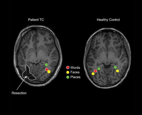 Children’s brains reorganize after epilepsy surgery to retain visual ...