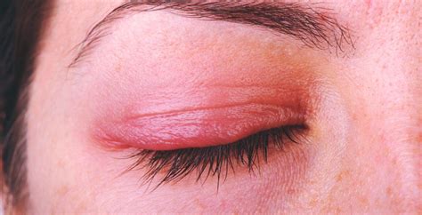 What's Causing My Funky Eyelid? | Dry eyelids, Allergy eyes, Swollen eyelids remedy