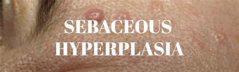 Sebaceous Hyperplasia Before And After