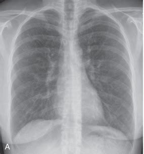 Cystic Lung Disease | Radiology Key