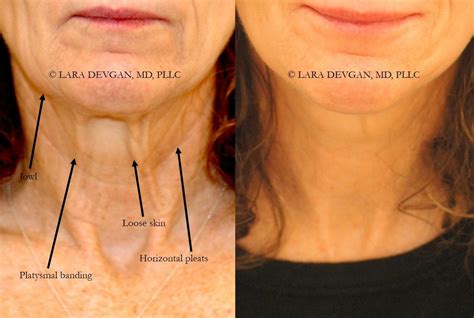 The key to a modern facelift and necklift — Lara Devgan, MD, MPH, FACS