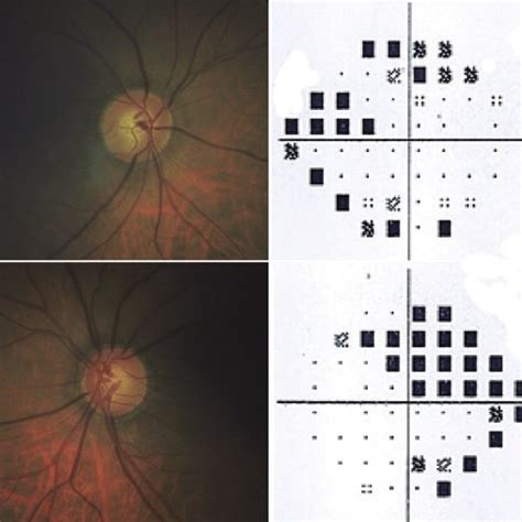 peripheral anterior synechiae in OD. Abbreviation: OD, right eye. | Download Scientific Diagram