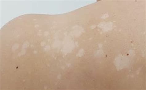 White Spots On Skin