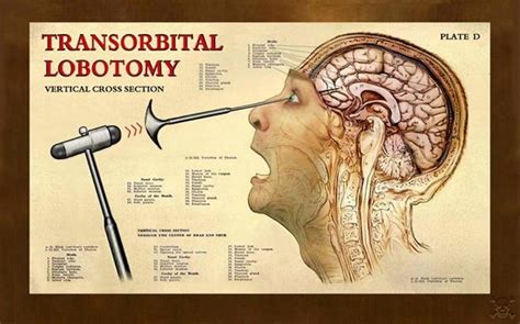 Lobotomy Before And After Brain