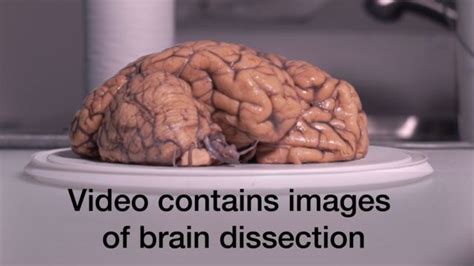 Dissecting brains for medical research - BBC News