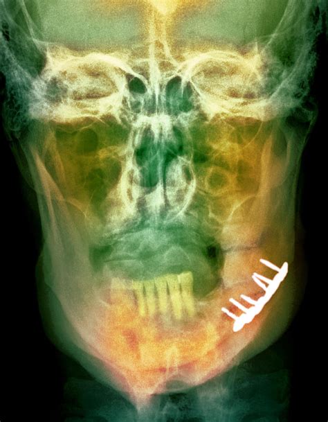 Pinned Broken Jaw, X-ray Photograph by