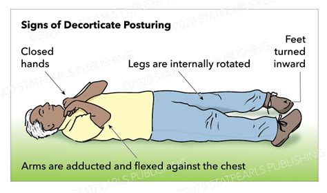 Decorticate Posturing - StatPearls - NCBI Bookshelf