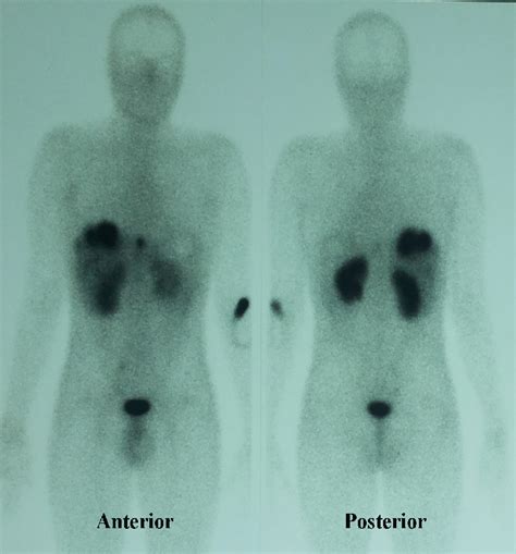 Whole-body Octreotide Scan image demonstrating abnormal hepatic tracer ...