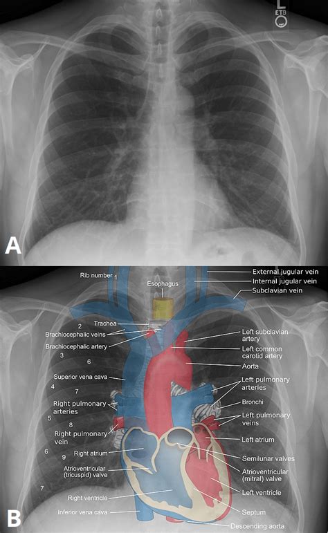 Plain Film X-Ray - Principles - Interpretation - TeachMeAnatomy