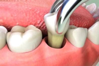 Average Cost for Tooth Extraction 2024 | UtoDent.com