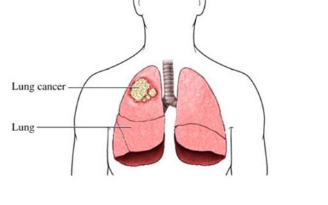 Do You Know These 14 Lung Cancer Symptoms? | SeeReadShare