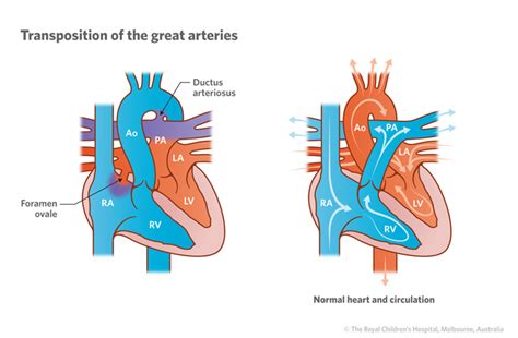 Cardiology : Transposition of the Great Arteries