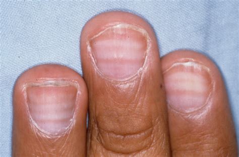 Lines across fingernails | MDedge Family Medicine