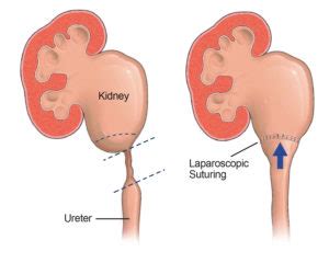 Urinary Obstruction and Ureteral Stricture: Causes and Treatment