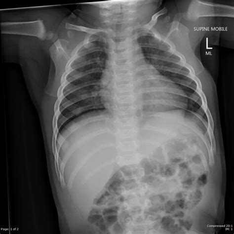 Epiglottitis and Croup - OpenAnesthesia