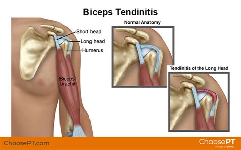 Guide | Physical Therapy Guide to Biceps Tendinitis | Choose PT