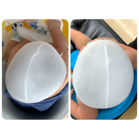 About Plagiocephaly – Children's Orthotics and Prosthetics