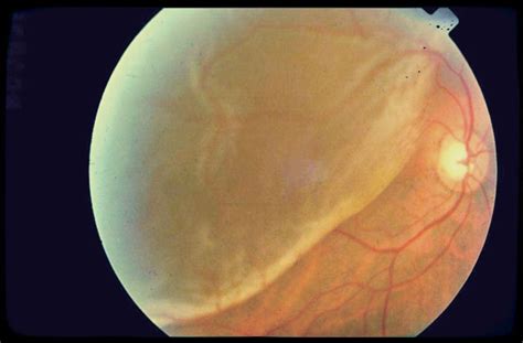 67 best images about Eye Diseases and Conditions on Pinterest | An eye, Medical information and ...