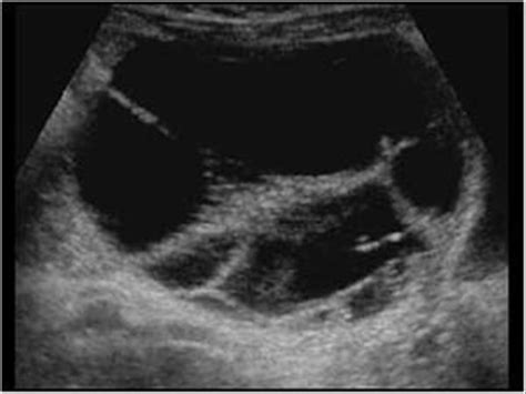 Gynaecology | 3.2 Adnexa : Case 3.2.1 Benign cystic lesions | Ultrasound Cases