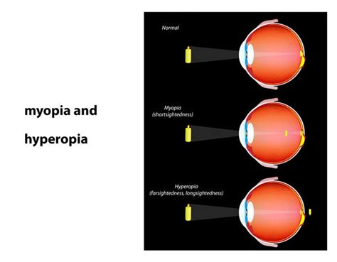 Refractive Errors | Virdieyeclinic