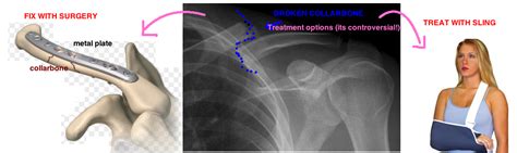 Does surgery for a broken collarbone have good results? — Bone Talks