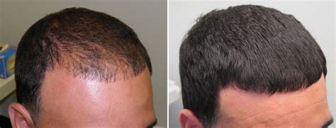 Hair Loss Treatment.jpg : hair loss treatment delhi on Rediff Pages