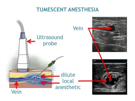 Endovenous Thermal Ablation Treatment in Mumbai - Dr. Avinash Katara Minimal Access Surgeon