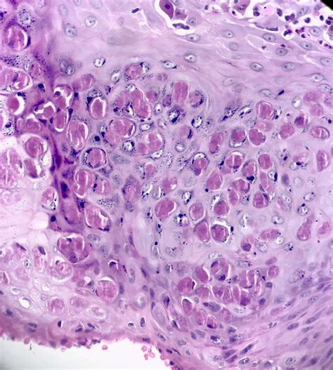 Molluscum Contagiosum