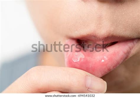 Woman Suffer Mouth Aphtha Stock Photo 694541032 | Shutterstock