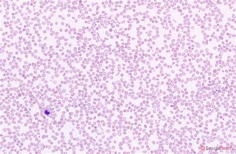 Haemoglobin H (HbH) Disease - LearnHaem | Haematology Made Simple