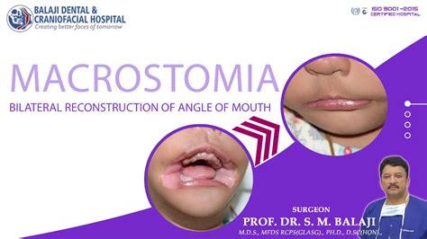 Macrostomia