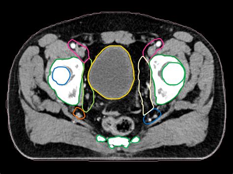 Autocontouring in radiation therapy - Siemens Healthineers - Siemens Healthineers