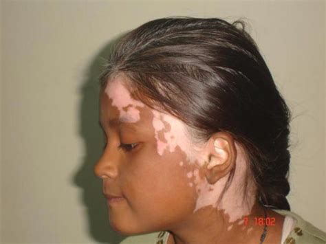 Vitiligo - An incurable skin disorder that may be helped naturally