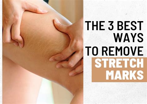 The 3 Best Ways to Remove Stretch Marks - D Luxe Lab