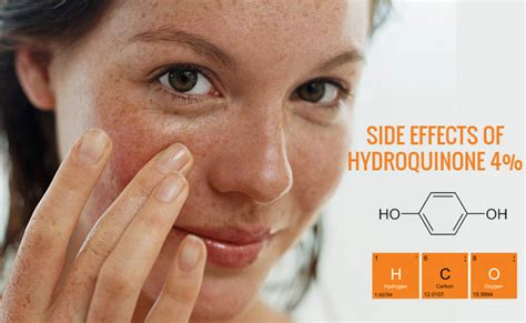 The Side Effects of Hydroquinone 4% - Sugar&Fluff