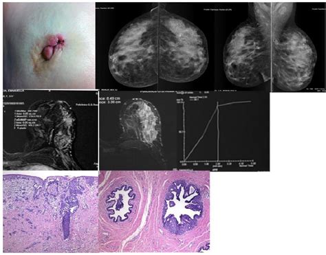 Figure 3 from MR aspects of Paget's disease of the breast: role in the staging of disease ...