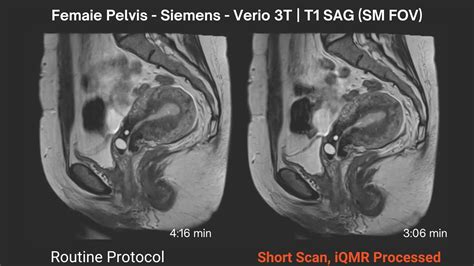 pelvis MRI Reduced female Appointment | Medic Vision