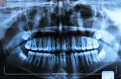 why were freddie mercury's teeth like that | ILAJAK Medical