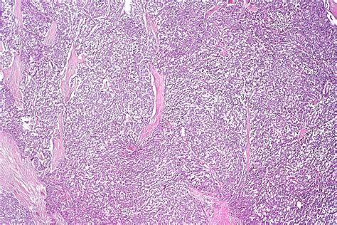 Ovarian germ cell tumor pathophysiology - wikidoc