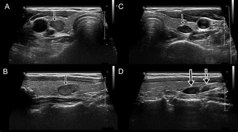 Parathyroid Ultrasound Anatomy