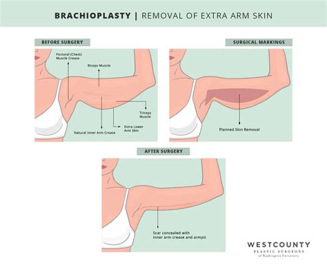 Arm Lift | St. Louis, MO | West County Plastic Surgeons