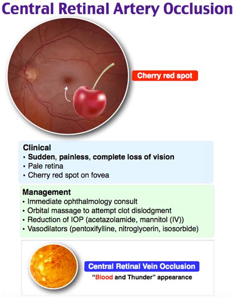 Retinal Artery Occlusion - IRAN Health Tourism Organizer - Iran Medical ...