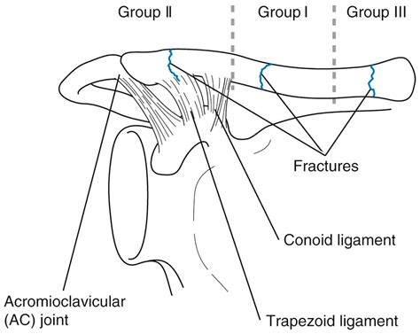 Clavicle Fracture Classification