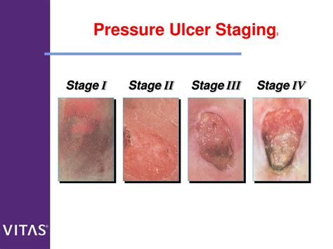 Turning Chart Pressure Ulcer